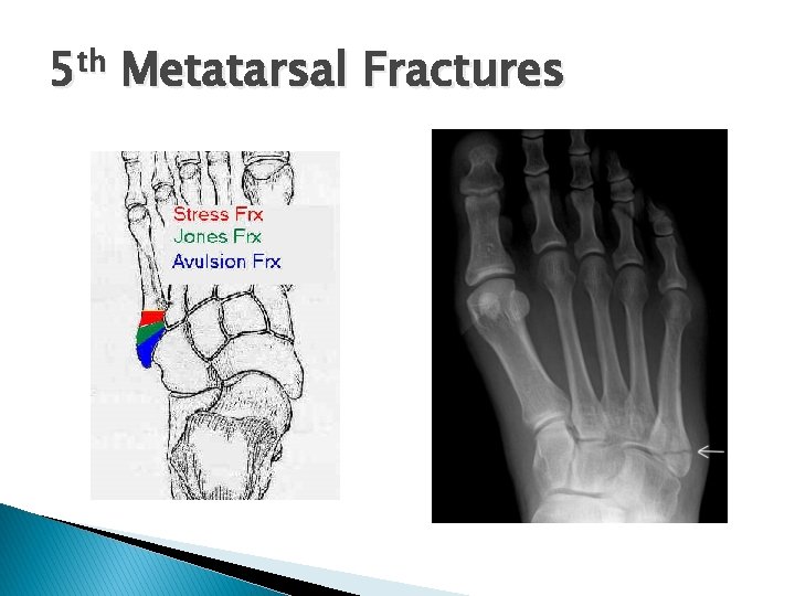 5 th Metatarsal Fractures 