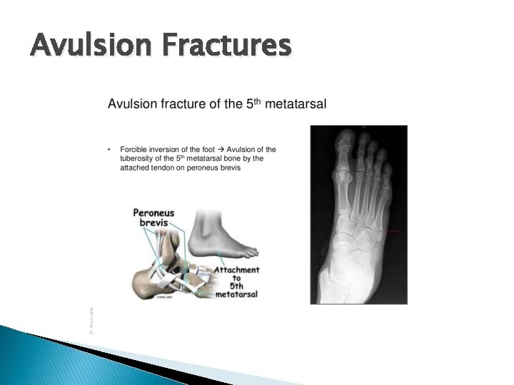 Avulsion Fractures 