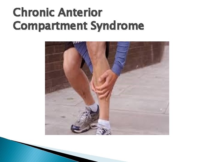 Chronic Anterior Compartment Syndrome 