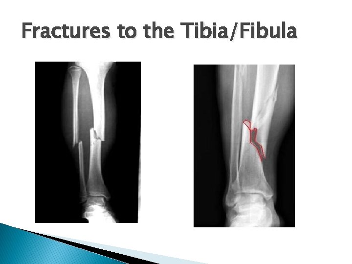 Fractures to the Tibia/Fibula 