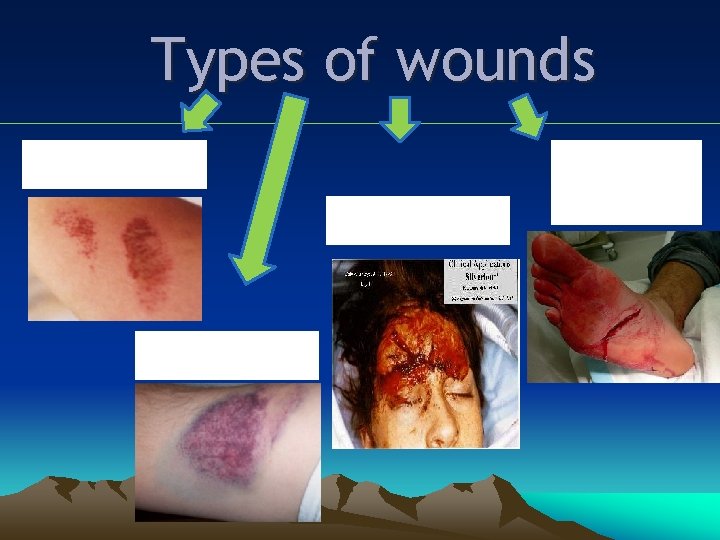 Types of wounds Abrasions Lacerations Bruises Incised Wounds 