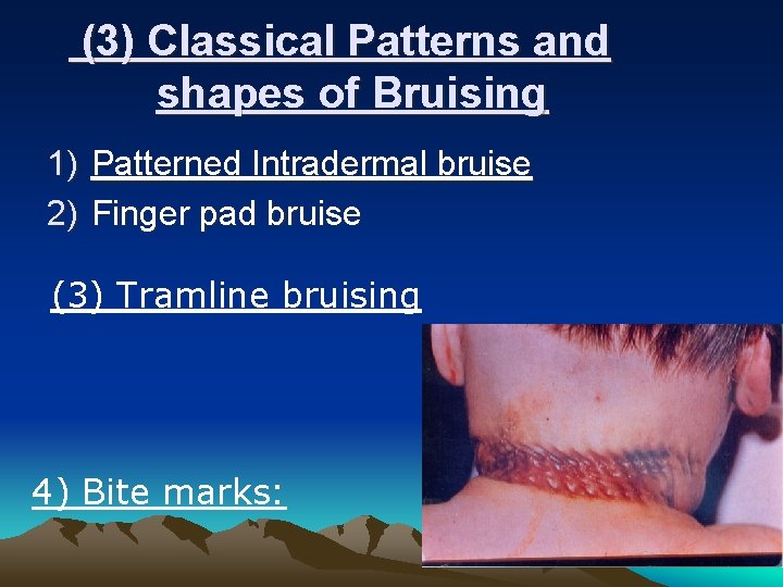 (3) Classical Patterns and shapes of Bruising 1) Patterned Intradermal bruise 2) Finger pad