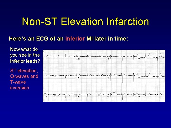 ECG Rhythm Interpretation Module VI Advanced 12 Lead