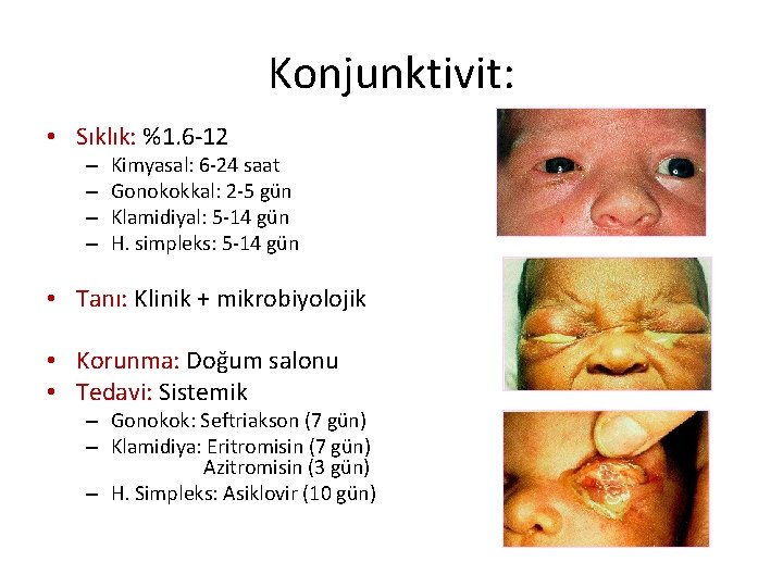 Konjunktivit: • Sıklık: %1. 6 -12 – – Kimyasal: 6 -24 saat Gonokokkal: 2