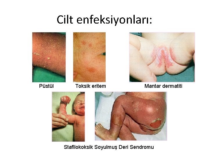Cilt enfeksiyonları: Püstül Toksik eritem Mantar dermatiti Stafilokoksik Soyulmuş Deri Sendromu 