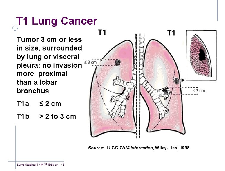 T 1 Lung Cancer Tumor 3 cm or less in size, surrounded by lung