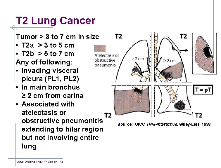 T 2 Lung Cancer Tumor > 3 to 7 cm in size • T