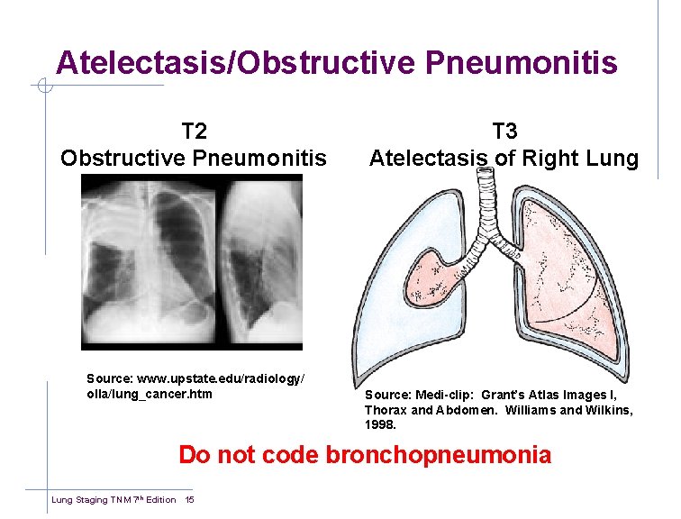 Atelectasis/Obstructive Pneumonitis T 2 Obstructive Pneumonitis Source: www. upstate. edu/radiology/ olla/lung_cancer. htm T 3