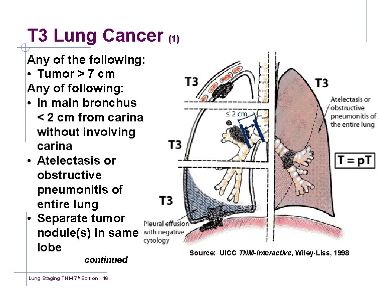 T 3 Lung Cancer (1) Any of the following: • Tumor > 7 cm