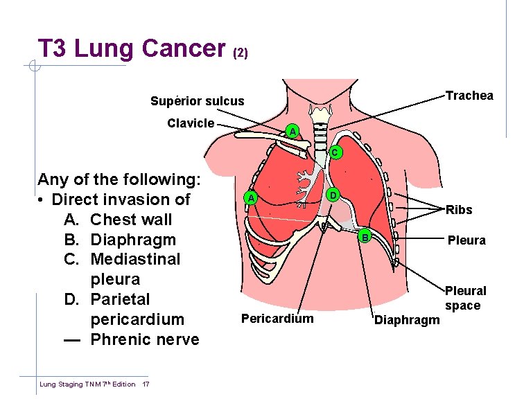 T 3 Lung Cancer (2) Trachea Superior sulcus Clavicle A C Any of the