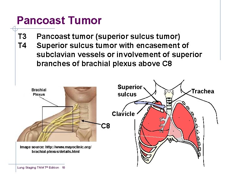 Pancoast Tumor T 3 T 4 Pancoast tumor (superior sulcus tumor) Superior sulcus tumor