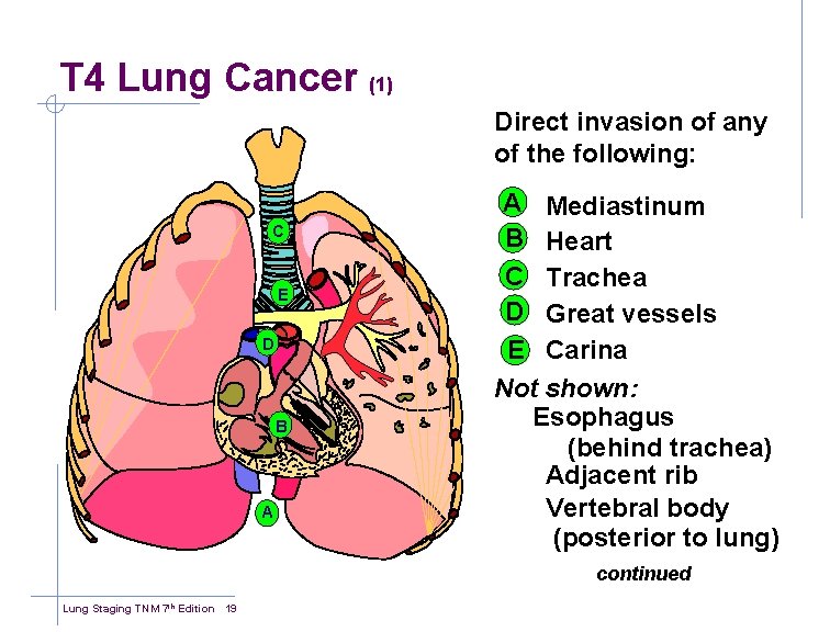 T 4 Lung Cancer (1) Direct invasion of any of the following: C E