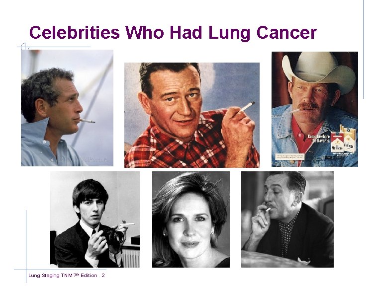 Celebrities Who Had Lung Cancer Lung Staging TNM 7 th Edition 2 