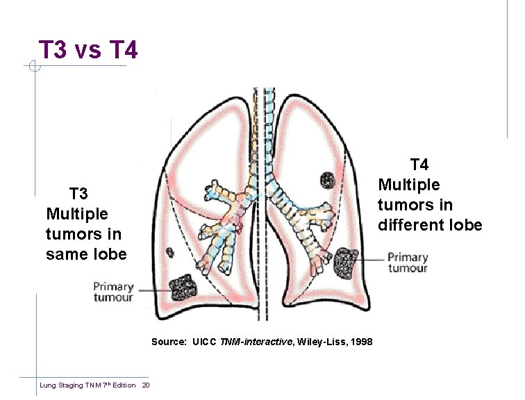 T 3 vs T 4 Multiple tumors in different lobe T 3 Multiple tumors