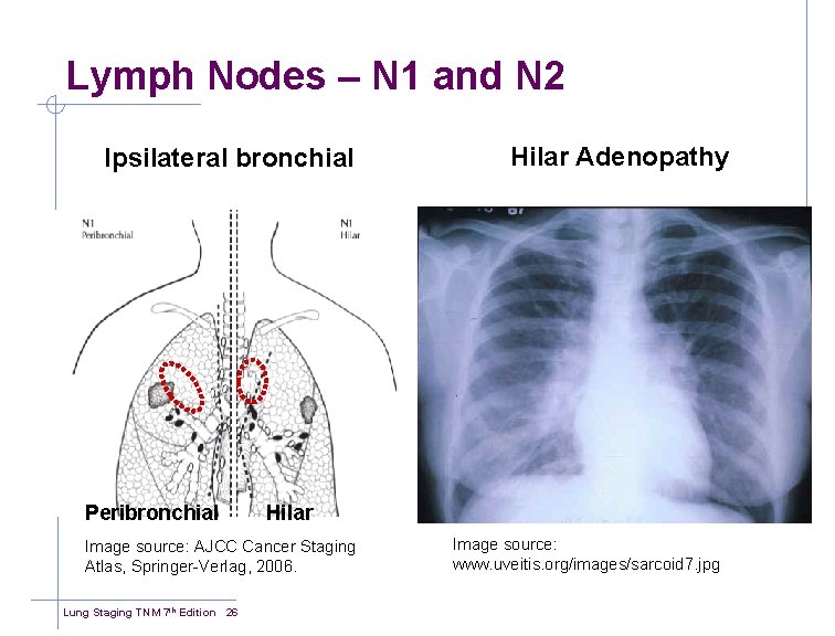 Lymph Nodes – N 1 and N 2 Ipsilateral bronchial Peribronchial Hilar Image source: