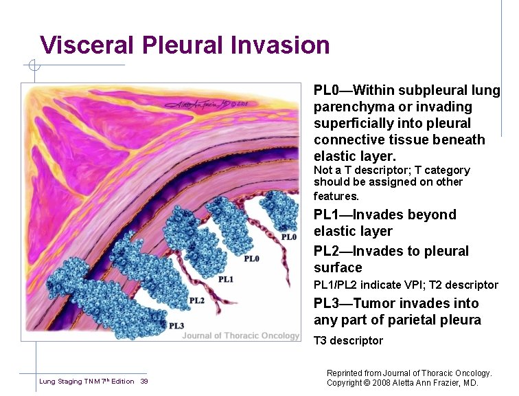 Visceral Pleural Invasion PL 0—Within subpleural lung parenchyma or invading superficially into pleural connective