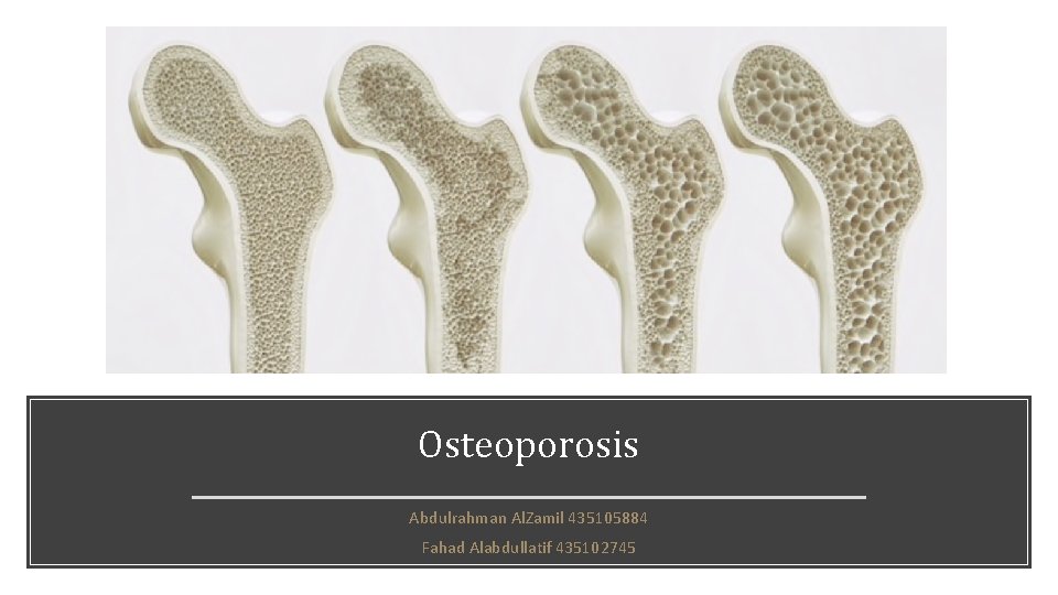 Osteoporosis Abdulrahman Al. Zamil 435105884 Fahad Alabdullatif 435102745 