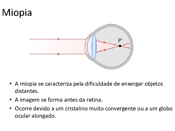 Miopia • A miopia se caracteriza pela dificuldade de enxergar objetos distantes. • A