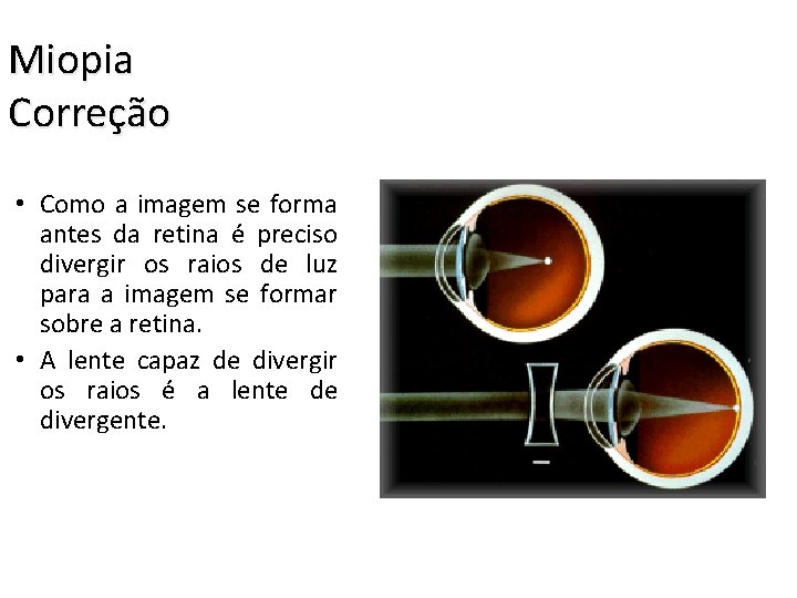 Miopia Correção • Como a imagem se forma antes da retina é preciso divergir