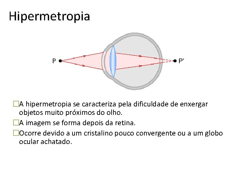 Hipermetropia �A hipermetropia se caracteriza pela dificuldade de enxergar objetos muito próximos do olho.