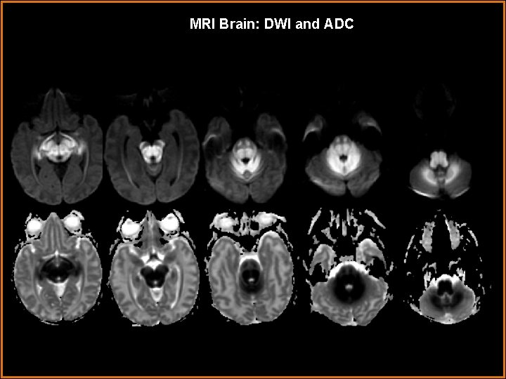 MRI Brain: DWI and ADC 