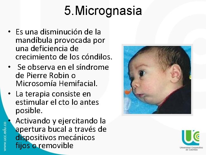 5. Micrognasia • Es una disminución de la mandíbula provocada por una deficiencia de 5. Micrognasia • Es una disminución de la mandíbula provocada por una deficiencia de