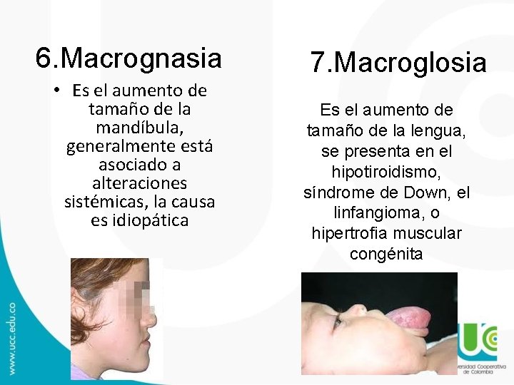 6. Macrognasia • Es el aumento de tamaño de la mandíbula, generalmente está asociado 6. Macrognasia • Es el aumento de tamaño de la mandíbula, generalmente está asociado