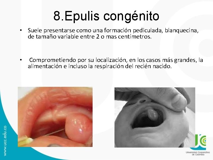 8. Epulis congénito • Suele presentarse como una formación pediculada, blanquecina, de tamaño variable 8. Epulis congénito • Suele presentarse como una formación pediculada, blanquecina, de tamaño variable