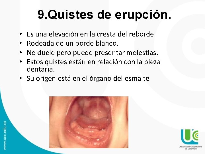 9. Quistes de erupción. Es una elevación en la cresta del reborde Rodeada de 9. Quistes de erupción. Es una elevación en la cresta del reborde Rodeada de