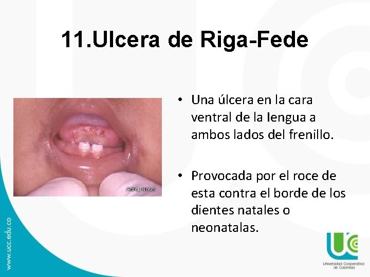 11. Ulcera de Riga-Fede • Una úlcera en la cara ventral de la Iengua 11. Ulcera de Riga-Fede • Una úlcera en la cara ventral de la Iengua