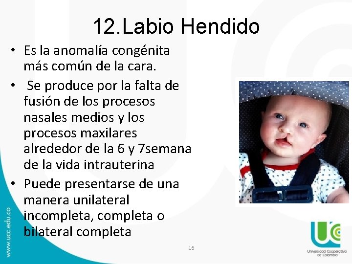 12. Labio Hendido • Es la anomalía congénita más común de la cara. • 12. Labio Hendido • Es la anomalía congénita más común de la cara. •