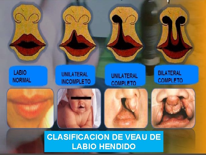 CLASIFICACION DE VEAU DE LABIO HENDIDO CLASIFICACION DE VEAU DE LABIO HENDIDO