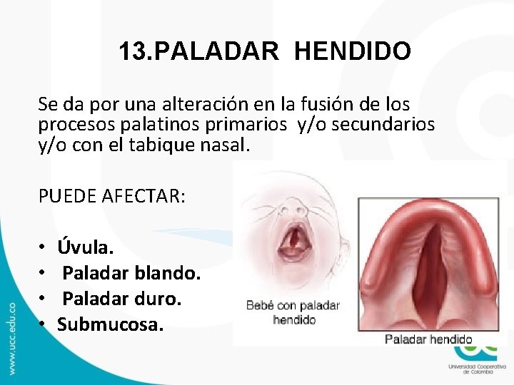 13. PALADAR HENDIDO Se da por una alteración en la fusión de los procesos 13. PALADAR HENDIDO Se da por una alteración en la fusión de los procesos