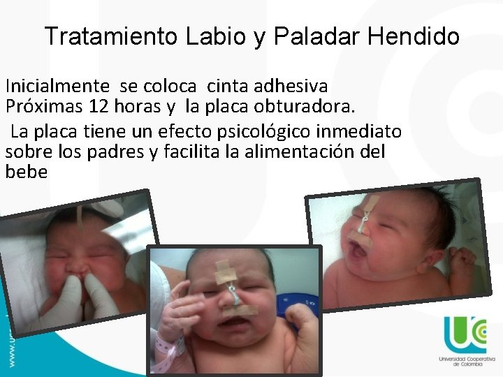 Tratamiento Labio y Paladar Hendido Inicialmente se coloca cinta adhesiva Próximas 12 horas y Tratamiento Labio y Paladar Hendido Inicialmente se coloca cinta adhesiva Próximas 12 horas y