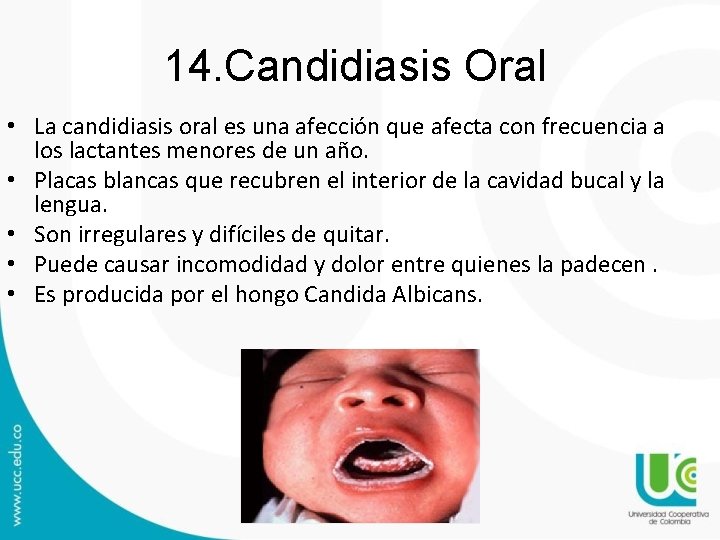 14. Candidiasis Oral • La candidiasis oral es una afección que afecta con frecuencia 14. Candidiasis Oral • La candidiasis oral es una afección que afecta con frecuencia