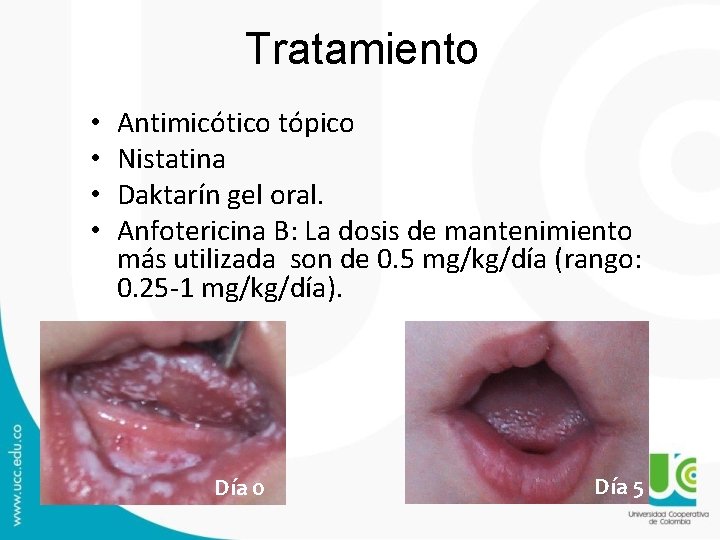 Tratamiento • • Antimicótico tópico Nistatina Daktarín gel oral. Anfotericina B: La dosis de Tratamiento • • Antimicótico tópico Nistatina Daktarín gel oral. Anfotericina B: La dosis de