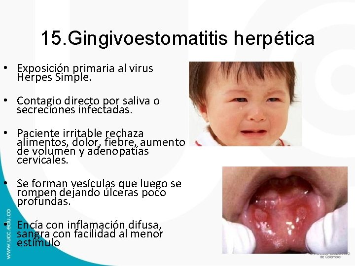 15. Gingivoestomatitis herpética • Exposición primaria al virus Herpes Simple. • Contagio directo por 15. Gingivoestomatitis herpética • Exposición primaria al virus Herpes Simple. • Contagio directo por