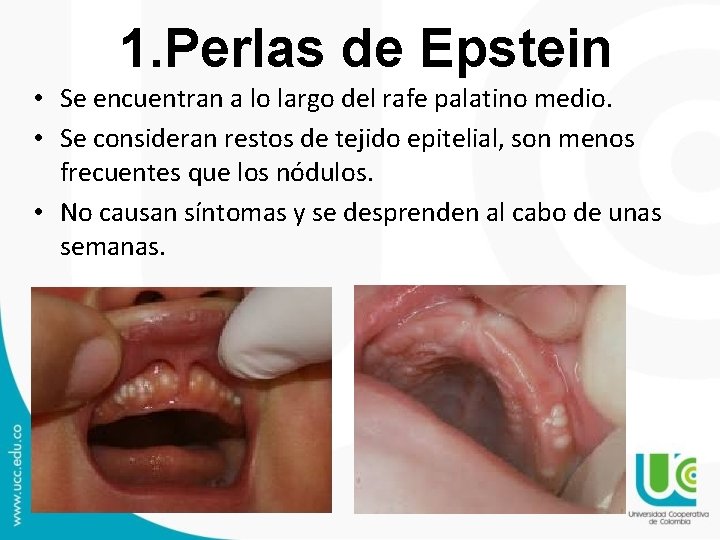 1. Perlas de Epstein • Se encuentran a lo largo del rafe palatino medio. 1. Perlas de Epstein • Se encuentran a lo largo del rafe palatino medio.