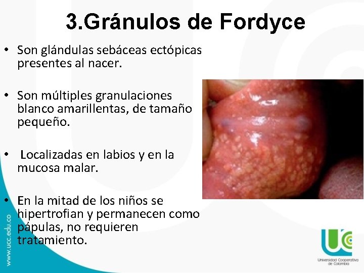 3. Gránulos de Fordyce • Son glándulas sebáceas ectópicas presentes al nacer. • Son 3. Gránulos de Fordyce • Son glándulas sebáceas ectópicas presentes al nacer. • Son