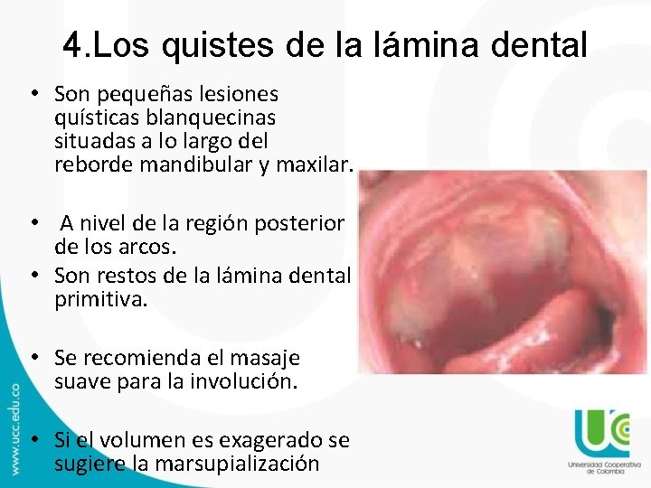 4. Los quistes de la lámina dental • Son pequeñas lesiones quísticas blanquecinas situadas 4. Los quistes de la lámina dental • Son pequeñas lesiones quísticas blanquecinas situadas
