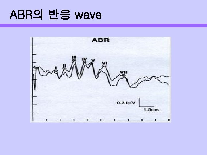 ABR의 반응 wave 