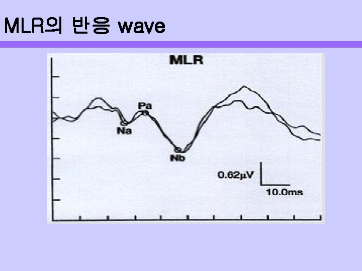 MLR의 반응 wave 