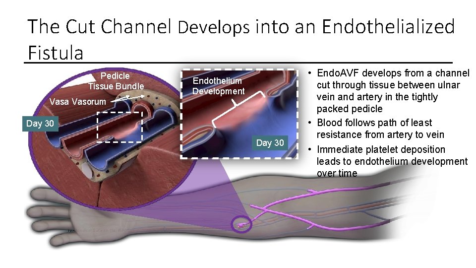 The Cut Channel Develops into an Endothelialized Fistula Pedicle Tissue Bundle Vasa Vasorum Endothelium The Cut Channel Develops into an Endothelialized Fistula Pedicle Tissue Bundle Vasa Vasorum Endothelium