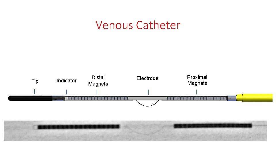 Venous Catheter Tip Indicator Distal Magnets Electrode Proximal Magnets Venous Catheter Tip Indicator Distal Magnets Electrode Proximal Magnets