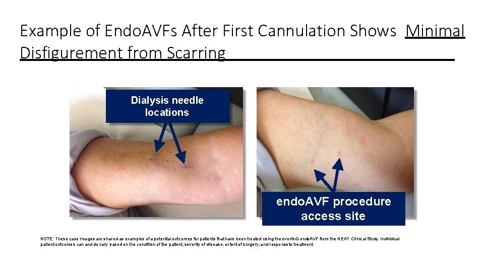 Example of Endo. AVFs After First Cannulation Shows Minimal Disfigurement from Scarring Dialysis needle Example of Endo. AVFs After First Cannulation Shows Minimal Disfigurement from Scarring Dialysis needle
