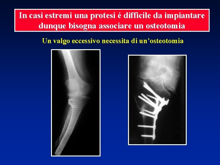 In casi estremi una protesi é difficile da impiantare dunque bisogna associare un osteotomia