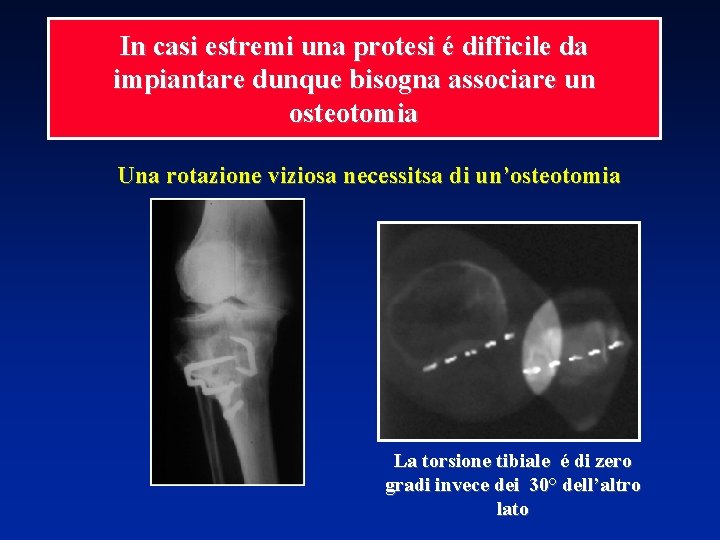 In casi estremi una protesi é difficile da impiantare dunque bisogna associare un osteotomia