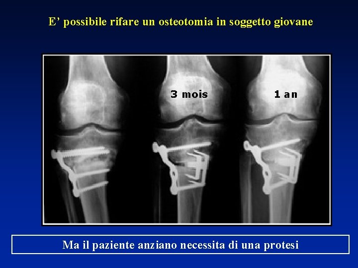 E’ possibile rifare un osteotomia in soggetto giovane 3 mois 1 an Ma il