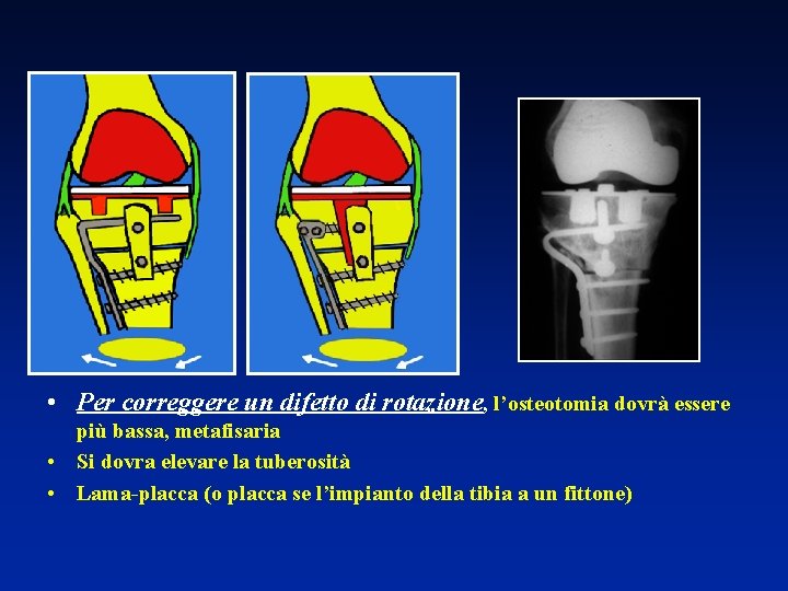  • Per correggere un difetto di rotazione, l’osteotomia dovrà essere più bassa, metafisaria