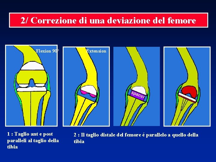 2/ Correzione di una deviazione del femore Flexion 90° 1 : Taglio ant e